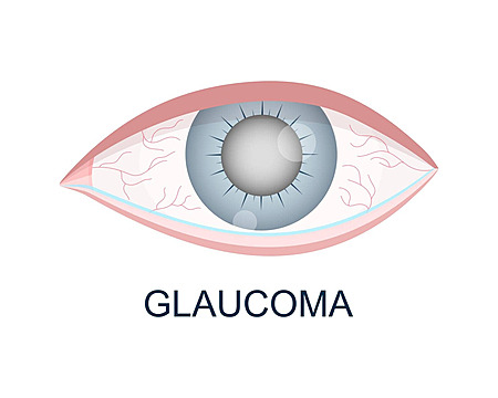 Glaucoma-Medical-Data-Analysis